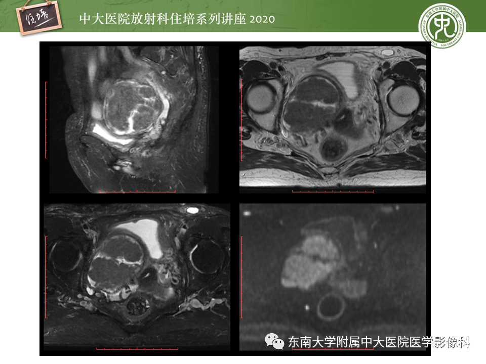 【PPT】女性盆腔实性占位性病变定位分析