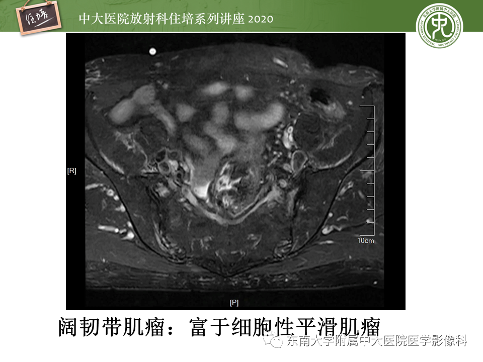 【PPT】女性盆腔实性占位性病变定位分析