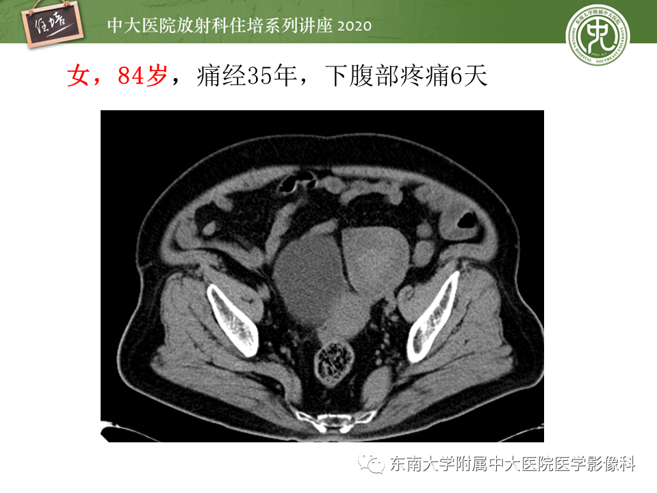 【PPT】女性盆腔实性占位性病变定位分析