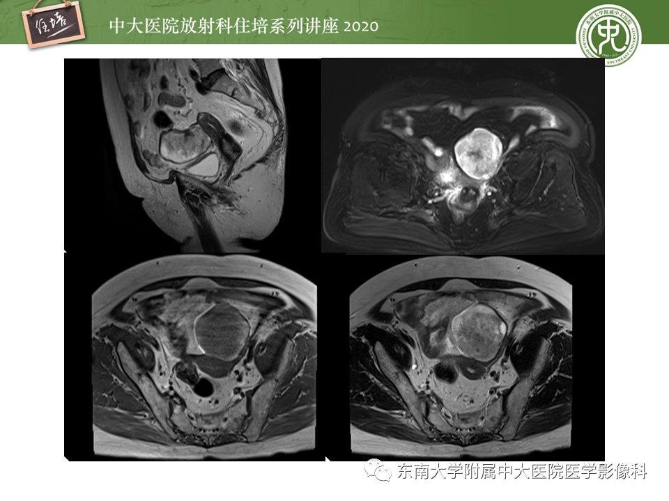 【PPT】女性盆腔实性占位性病变定位分析
