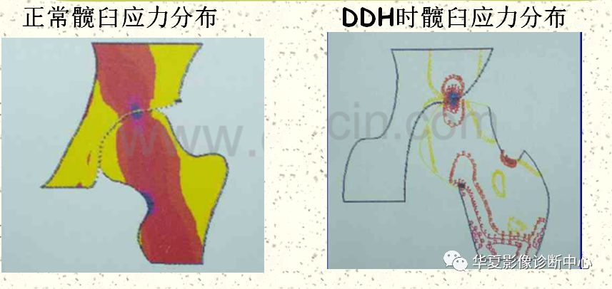 先天性髋关节脱位