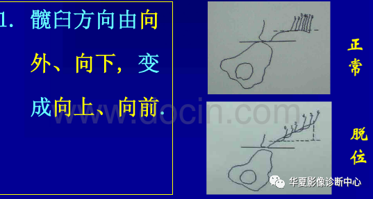 先天性髋关节脱位