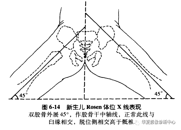 先天性髋关节脱位