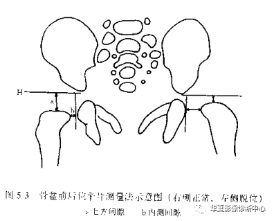 先天性髋关节脱位