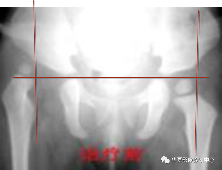 先天性髋关节脱位