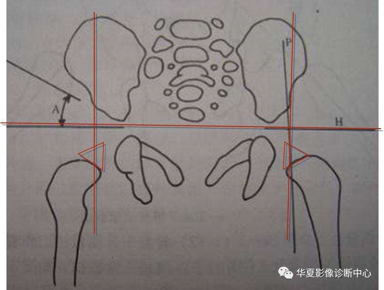先天性髋关节脱位
