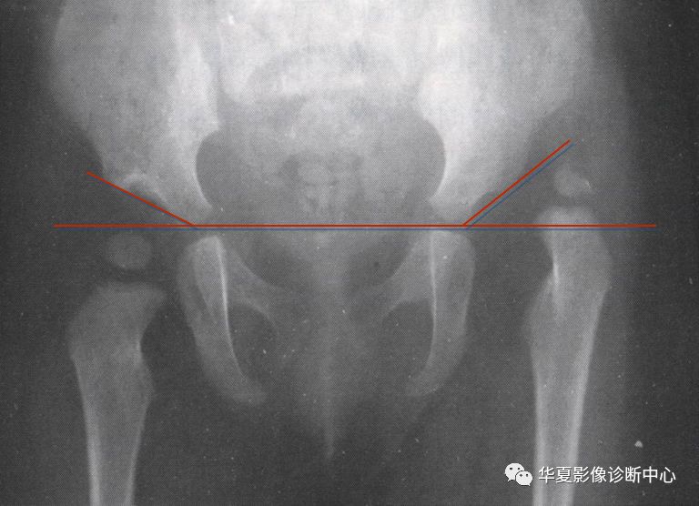 先天性髋关节脱位