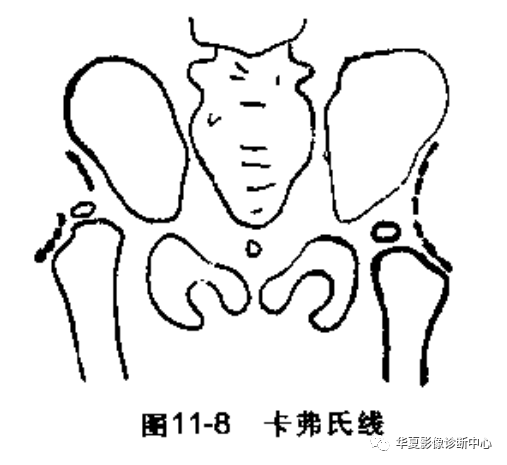 先天性髋关节脱位