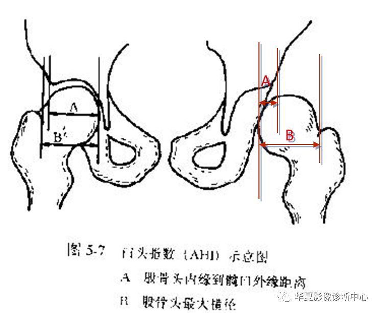 先天性髋关节脱位