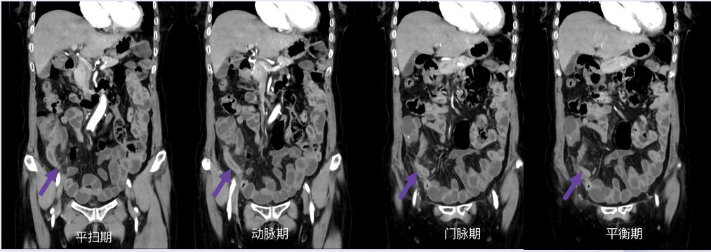 CT 片上总是找不到阑尾?3 步法教你快速定位 CT 片上总是找不到阑尾?3 步法教你快速定位