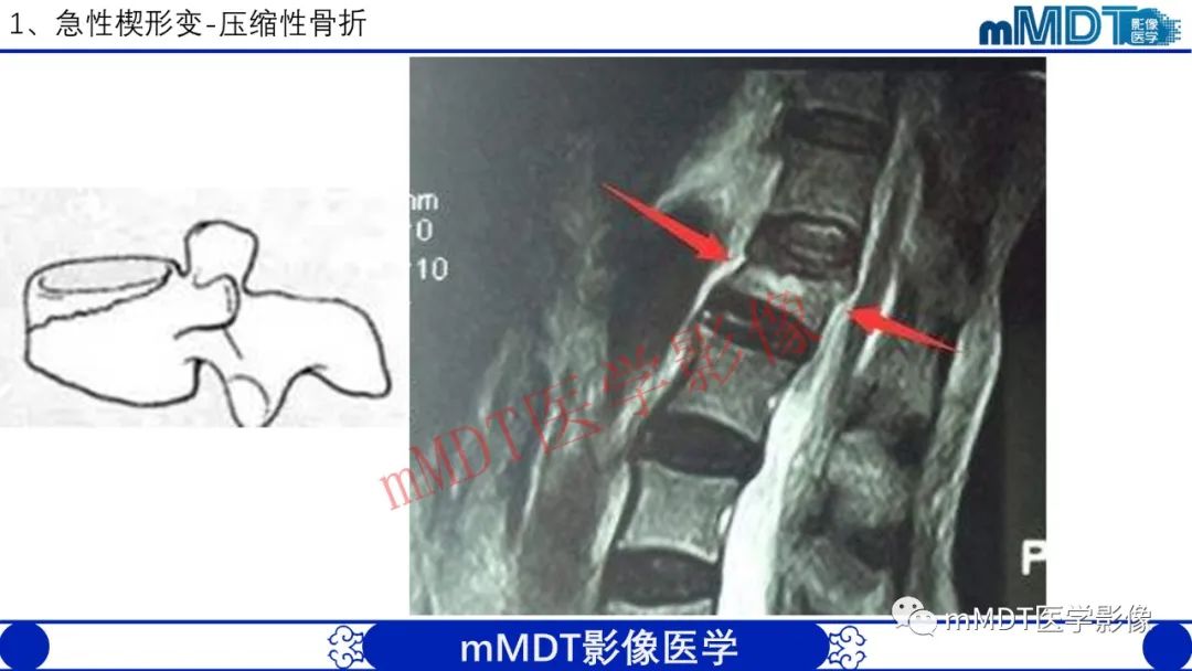 【PPT】从椎体形态判断疾病