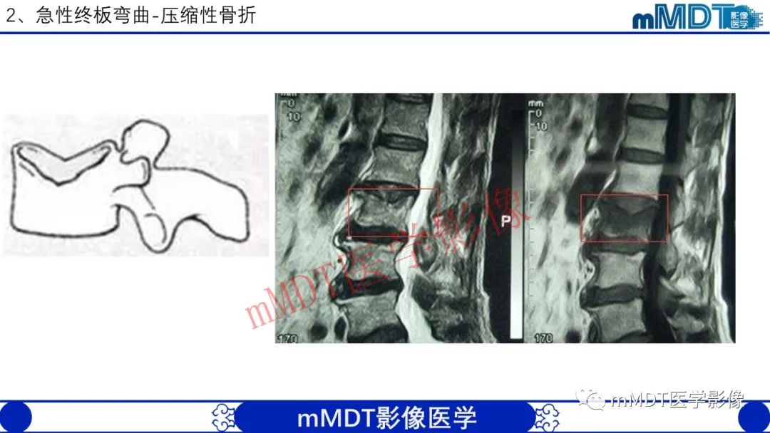 【PPT】从椎体形态判断疾病