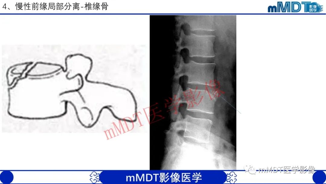 【PPT】从椎体形态判断疾病