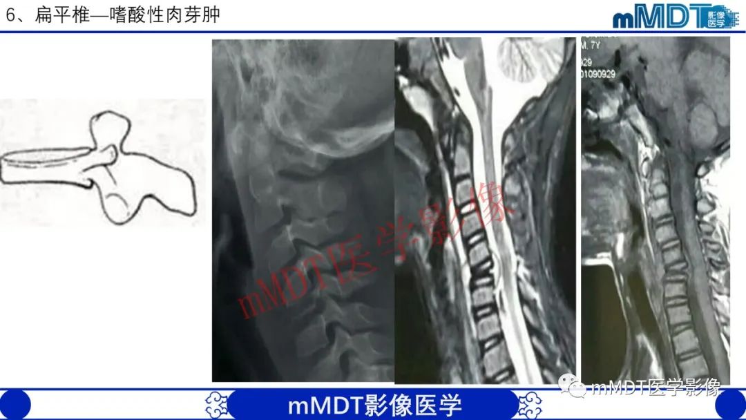 【PPT】从椎体形态判断疾病