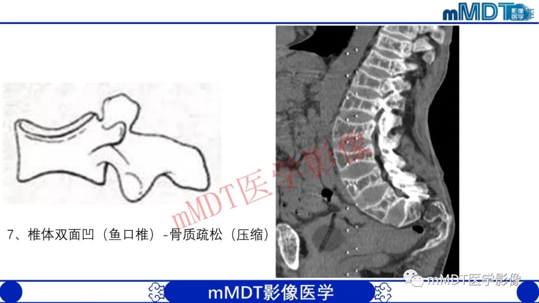 【PPT】从椎体形态判断疾病