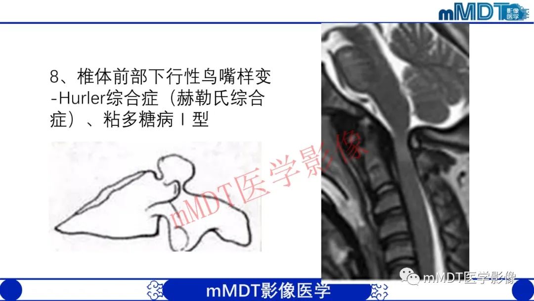 【PPT】从椎体形态判断疾病