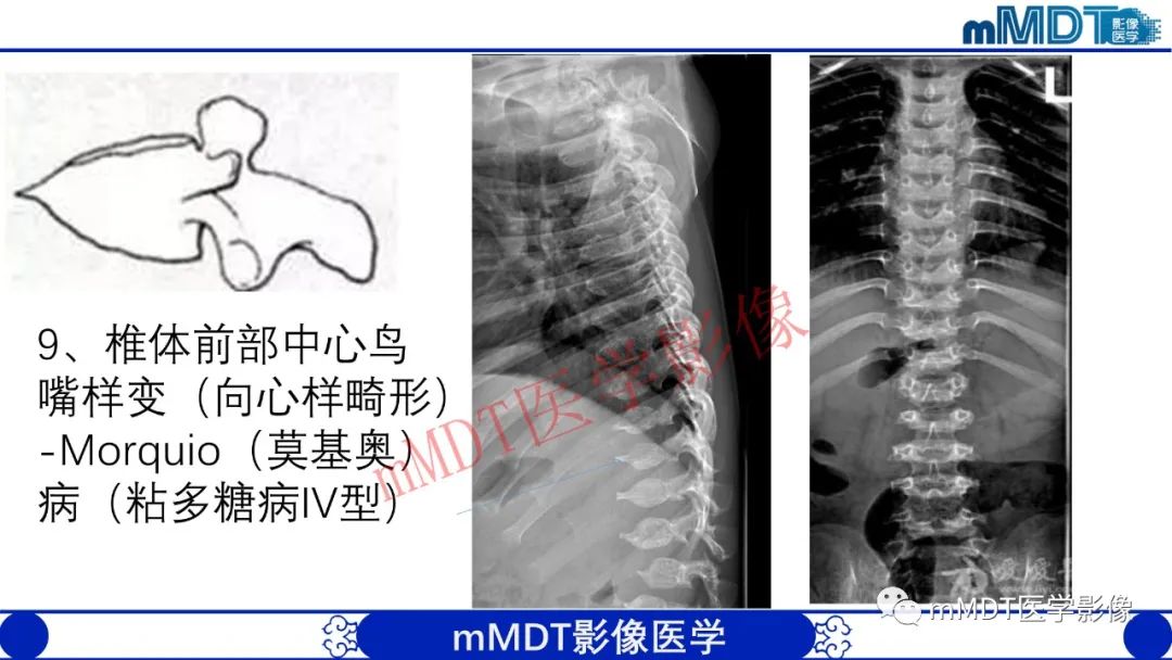 【PPT】从椎体形态判断疾病