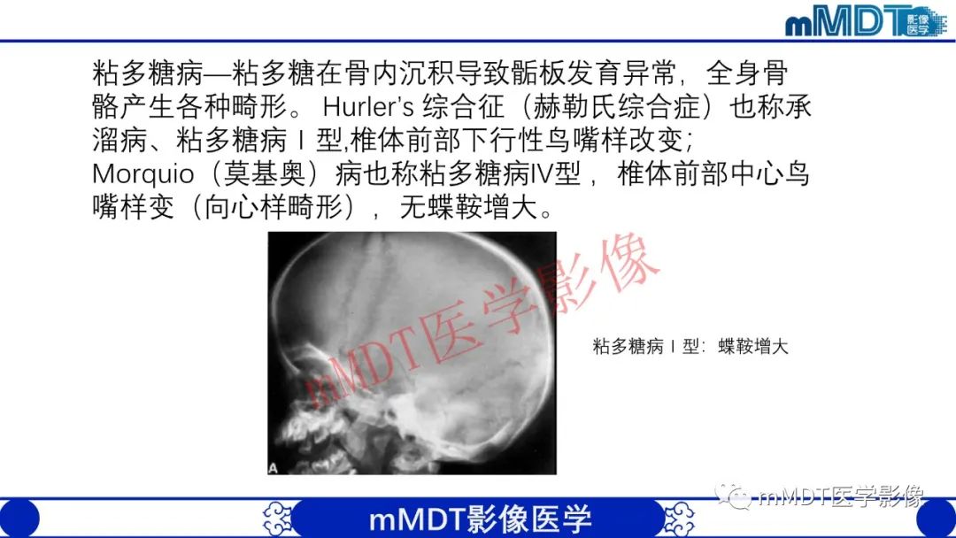 【PPT】从椎体形态判断疾病