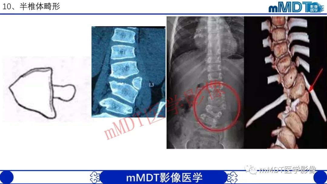 【PPT】从椎体形态判断疾病
