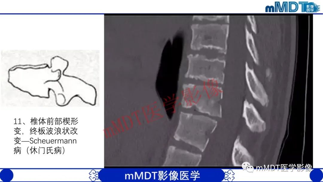 【PPT】从椎体形态判断疾病