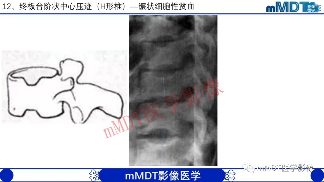 【PPT】从椎体形态判断疾病