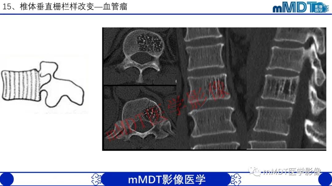 【PPT】从椎体形态判断疾病