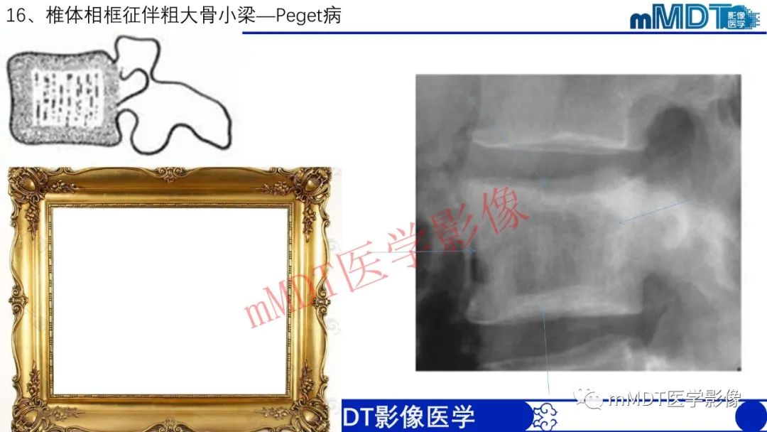 【PPT】从椎体形态判断疾病