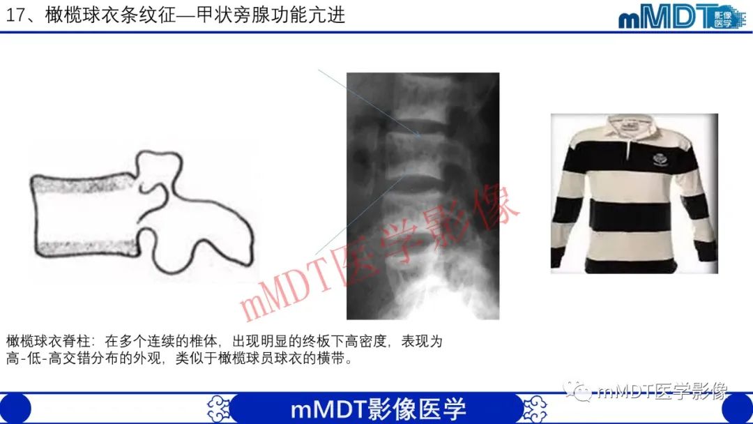 【PPT】从椎体形态判断疾病
