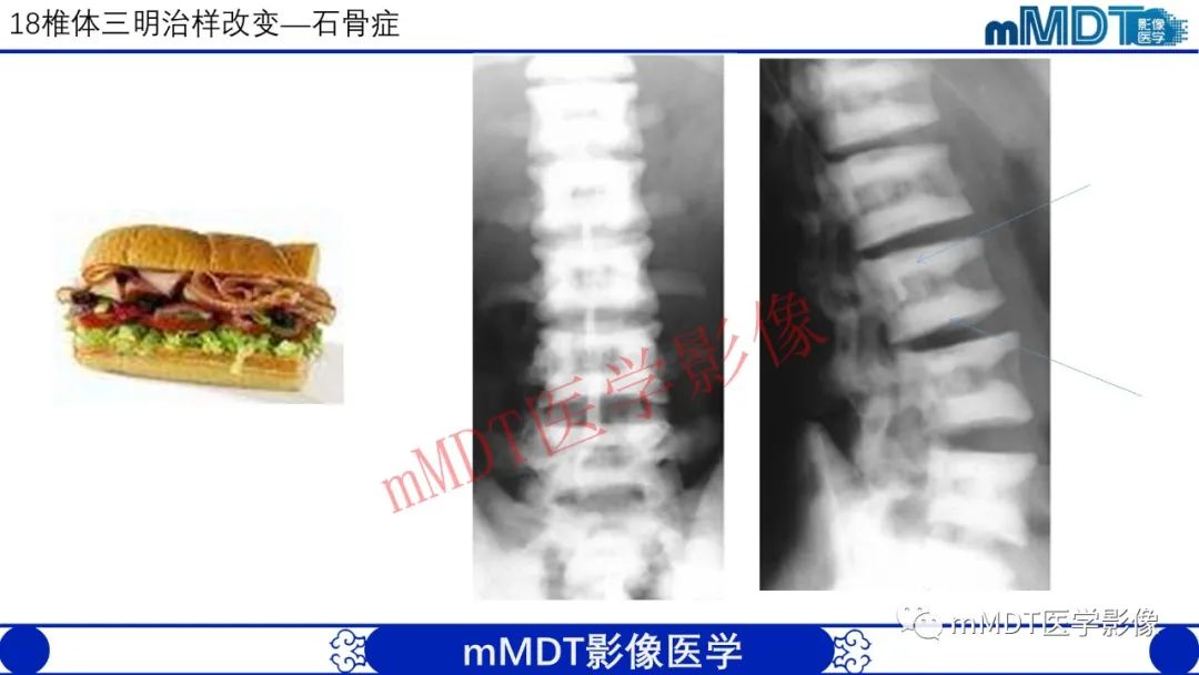 【PPT】从椎体形态判断疾病