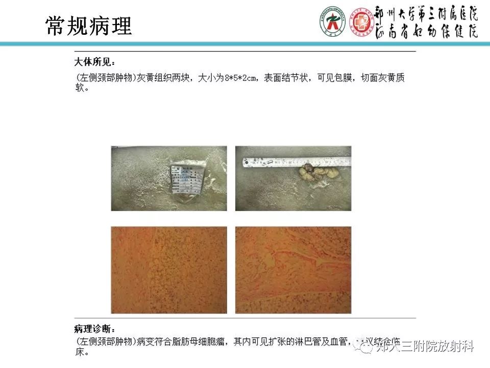 【病例】儿童颈部脂肪母细胞瘤影像诊断