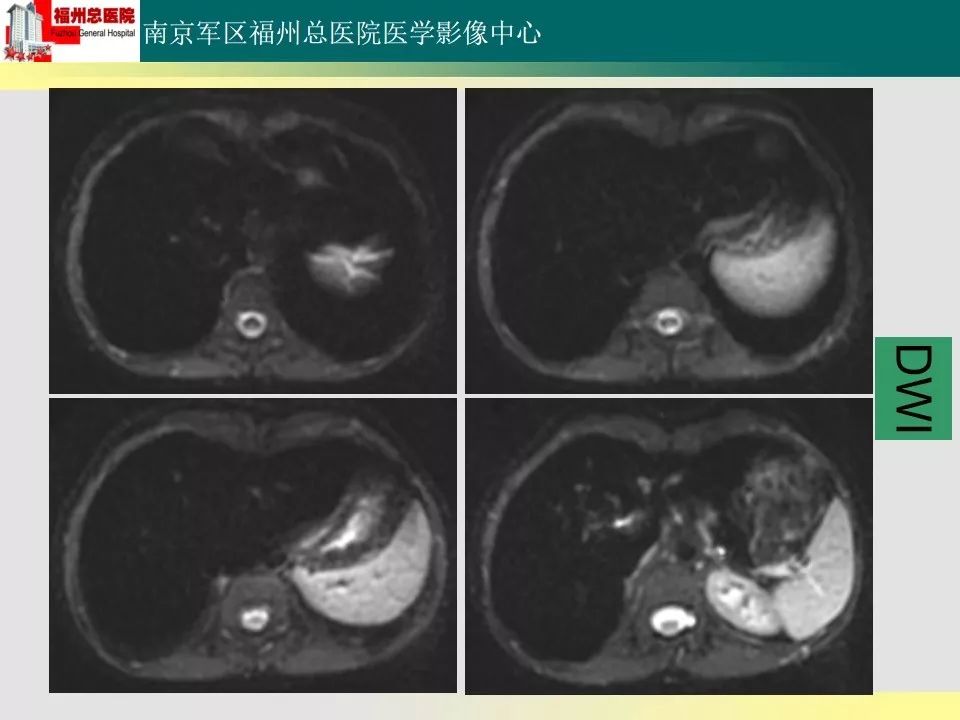【PPT】肝血色病影像表现及鉴别诊断