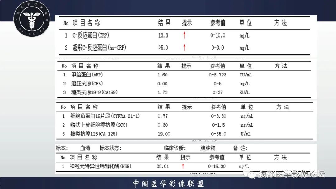 【病例】脾脏弥漫性大B细胞淋巴瘤1例MR影像讨论 【病例】脾脏弥漫性大B细胞淋巴瘤1例MR影像讨论