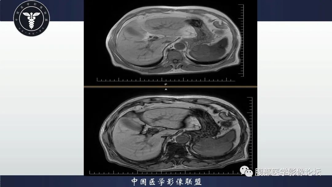 【病例】脾脏弥漫性大B细胞淋巴瘤1例MR影像讨论 【病例】脾脏弥漫性大B细胞淋巴瘤1例MR影像讨论