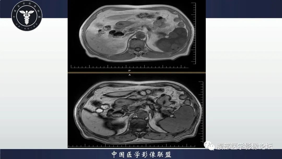 【病例】脾脏弥漫性大B细胞淋巴瘤1例MR影像讨论 【病例】脾脏弥漫性大B细胞淋巴瘤1例MR影像讨论