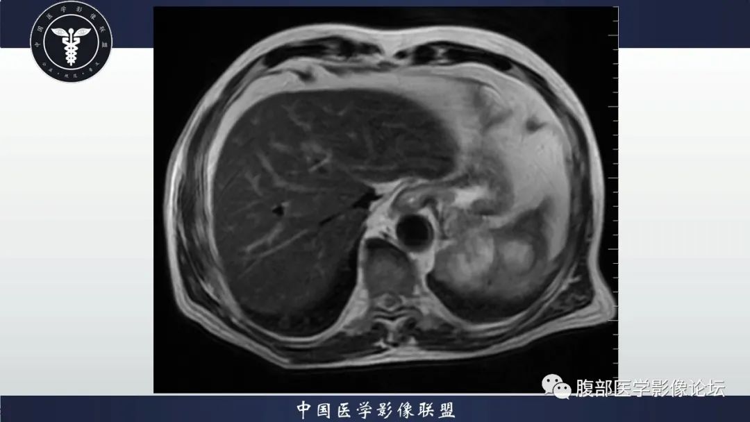【病例】脾脏弥漫性大B细胞淋巴瘤1例MR影像讨论 【病例】脾脏弥漫性大B细胞淋巴瘤1例MR影像讨论