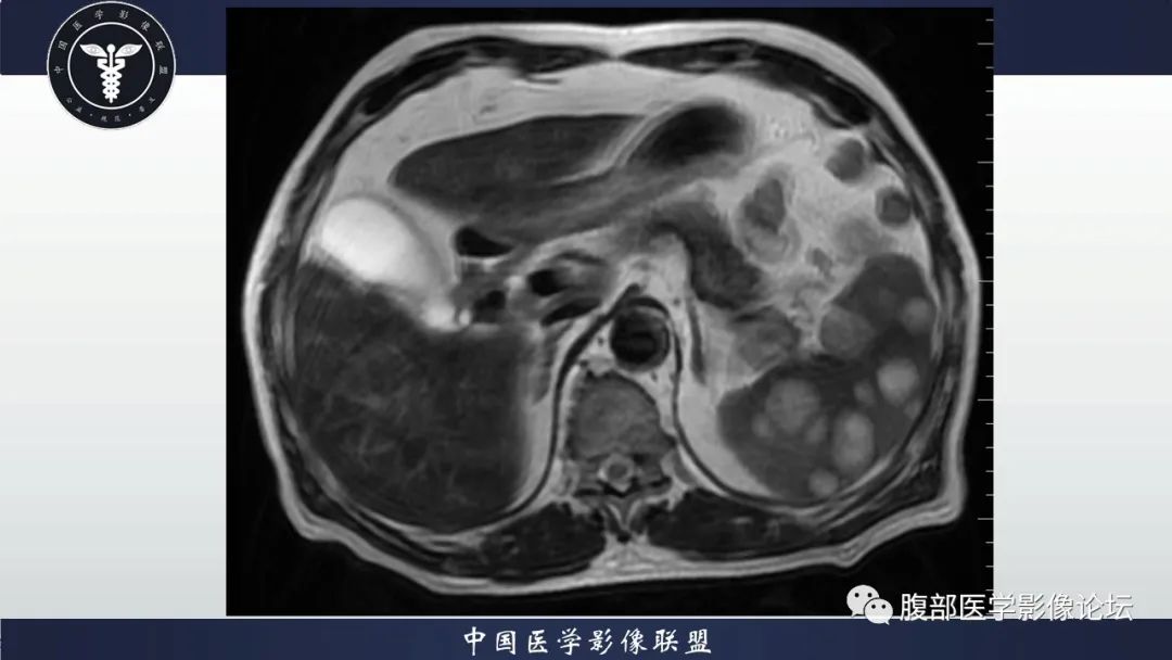 【病例】脾脏弥漫性大B细胞淋巴瘤1例MR影像讨论 【病例】脾脏弥漫性大B细胞淋巴瘤1例MR影像讨论