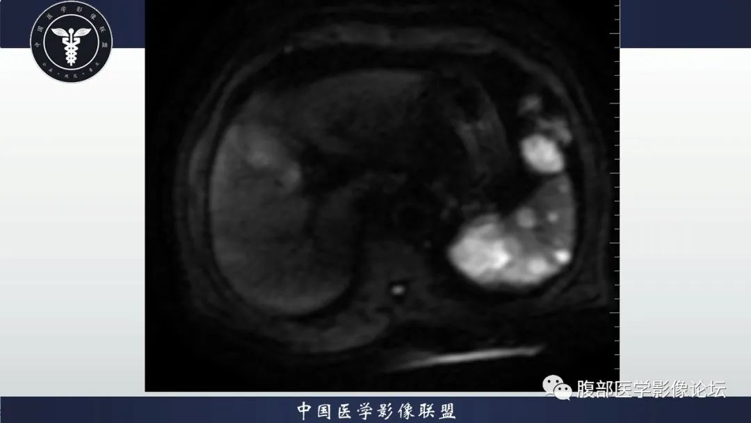 【病例】脾脏弥漫性大B细胞淋巴瘤1例MR影像讨论 【病例】脾脏弥漫性大B细胞淋巴瘤1例MR影像讨论