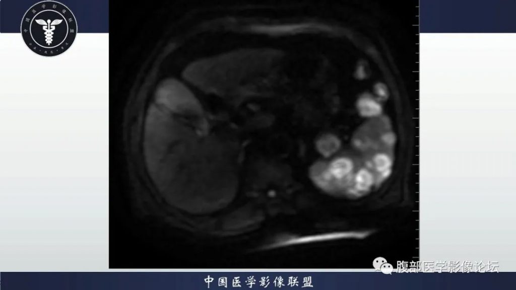 【病例】脾脏弥漫性大B细胞淋巴瘤1例MR影像讨论