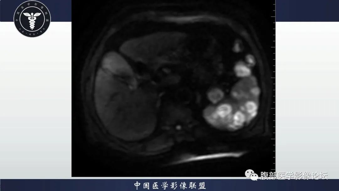 【病例】脾脏弥漫性大B细胞淋巴瘤1例MR影像讨论 【病例】脾脏弥漫性大B细胞淋巴瘤1例MR影像讨论