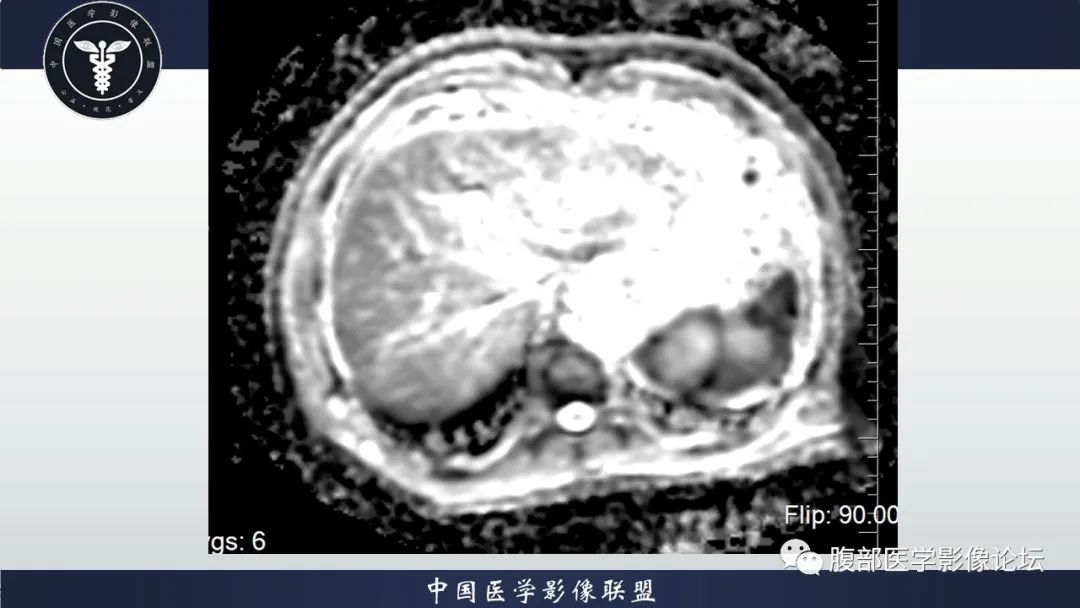 【病例】脾脏弥漫性大B细胞淋巴瘤1例MR影像讨论 【病例】脾脏弥漫性大B细胞淋巴瘤1例MR影像讨论