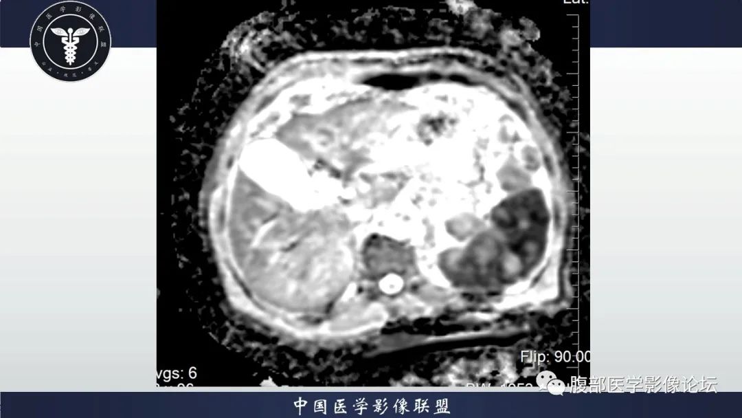 【病例】脾脏弥漫性大B细胞淋巴瘤1例MR影像讨论 【病例】脾脏弥漫性大B细胞淋巴瘤1例MR影像讨论