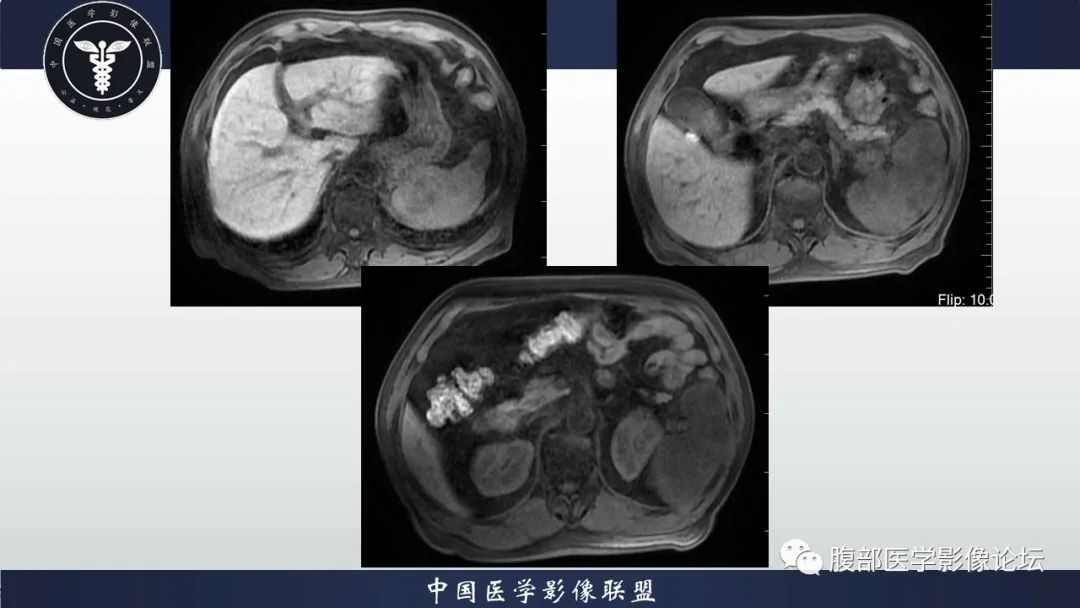 【病例】脾脏弥漫性大B细胞淋巴瘤1例MR影像讨论 【病例】脾脏弥漫性大B细胞淋巴瘤1例MR影像讨论