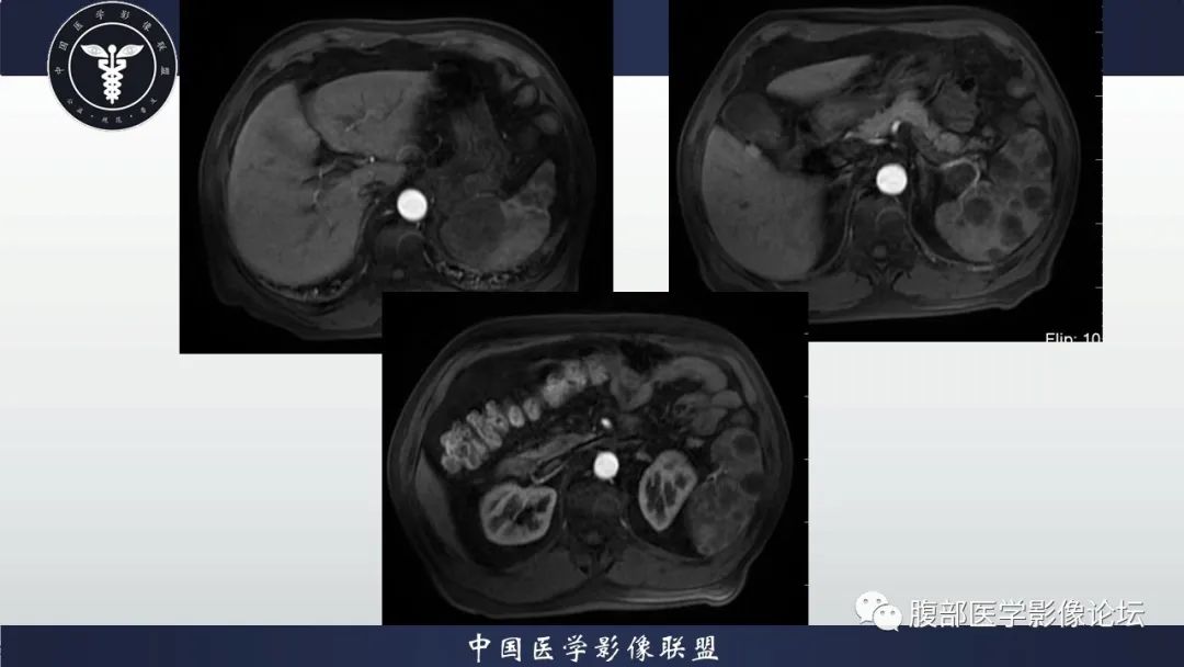 【病例】脾脏弥漫性大B细胞淋巴瘤1例MR影像讨论 【病例】脾脏弥漫性大B细胞淋巴瘤1例MR影像讨论