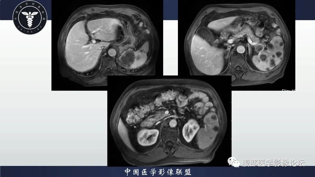【病例】脾脏弥漫性大B细胞淋巴瘤1例MR影像讨论 【病例】脾脏弥漫性大B细胞淋巴瘤1例MR影像讨论