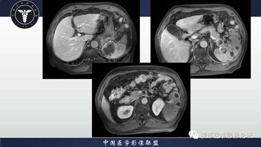 【病例】脾脏弥漫性大B细胞淋巴瘤1例MR影像讨论 【病例】脾脏弥漫性大B细胞淋巴瘤1例MR影像讨论
