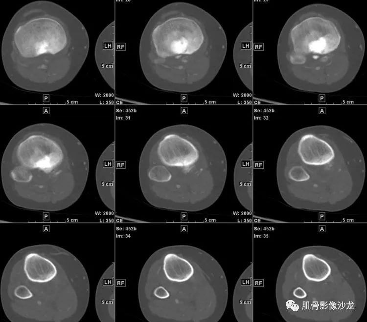 【病例】胫骨骨肉瘤1例CT影像 【病例】胫骨骨肉瘤1例CT影像