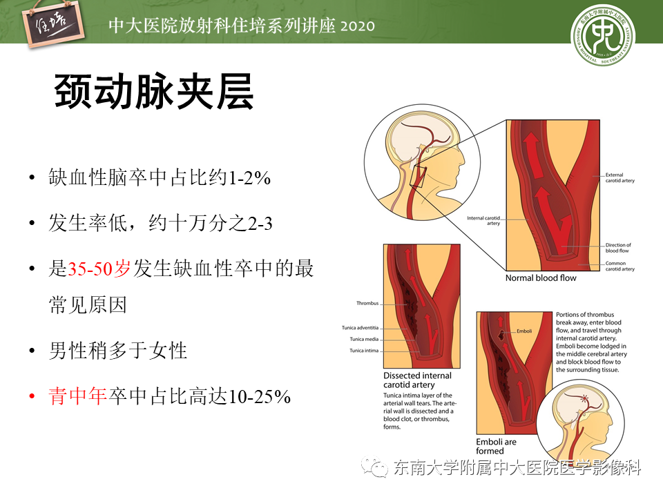 【PPT】颈动脉夹层及夹层动脉瘤的影像诊断及评估