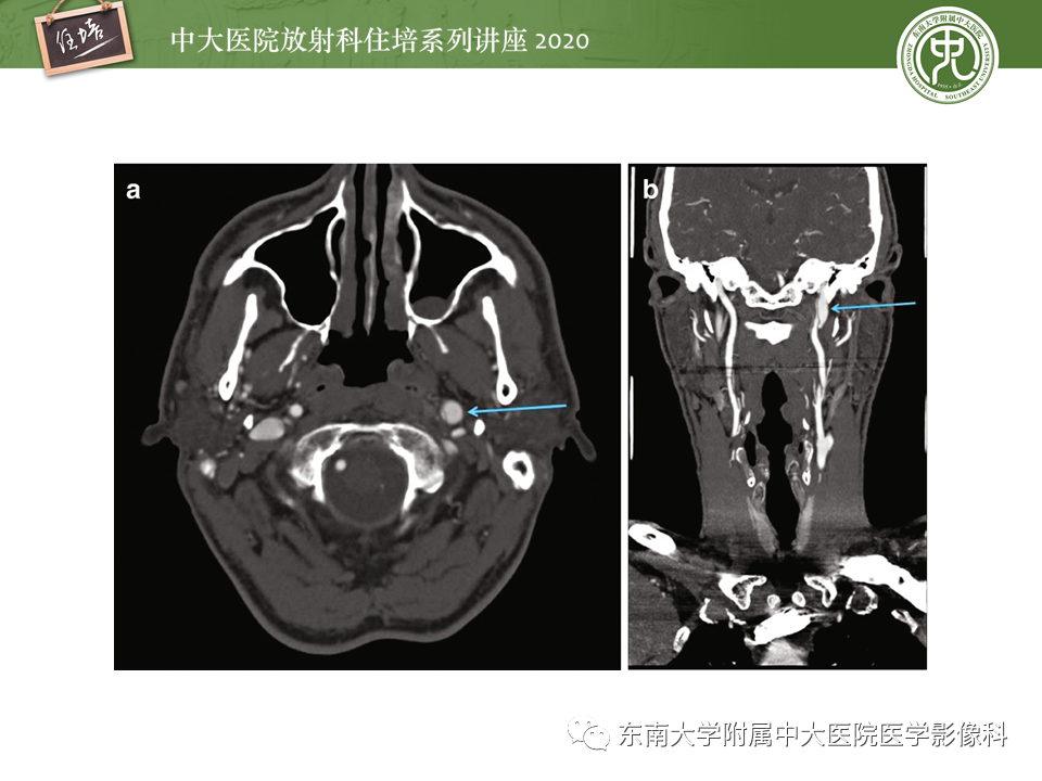 【PPT】颈动脉夹层及夹层动脉瘤的影像诊断及评估