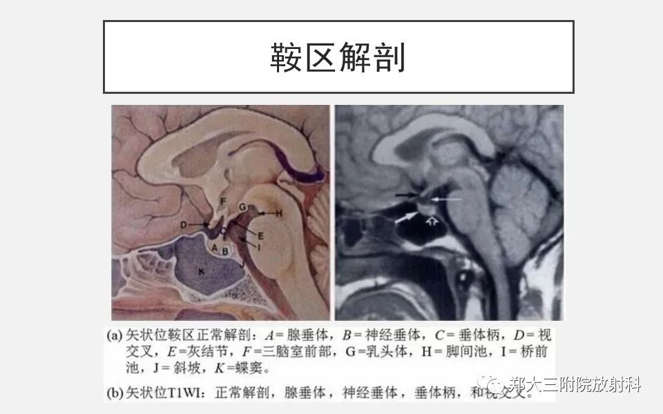 【PPT】垂体增生的影像表现