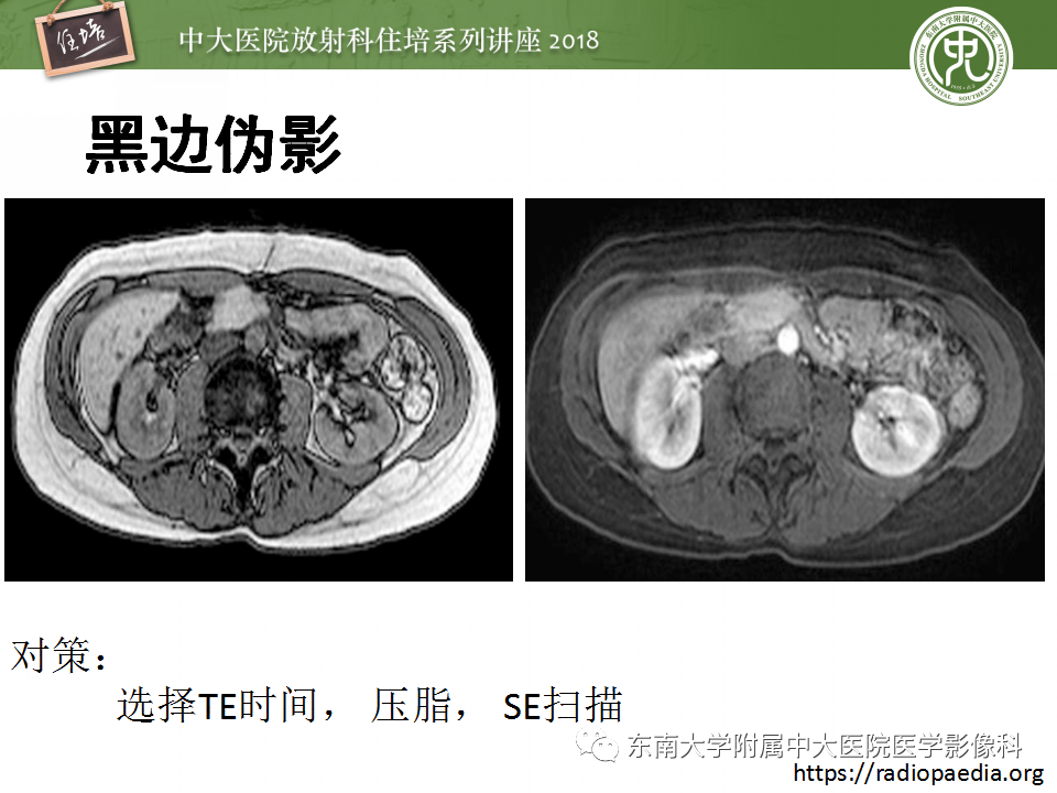 【PPT】磁共振成像常见伪影